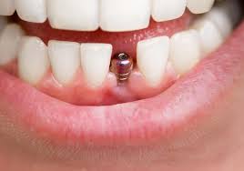 Same-Day Dental Implants