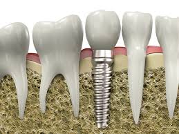 Dental Implants